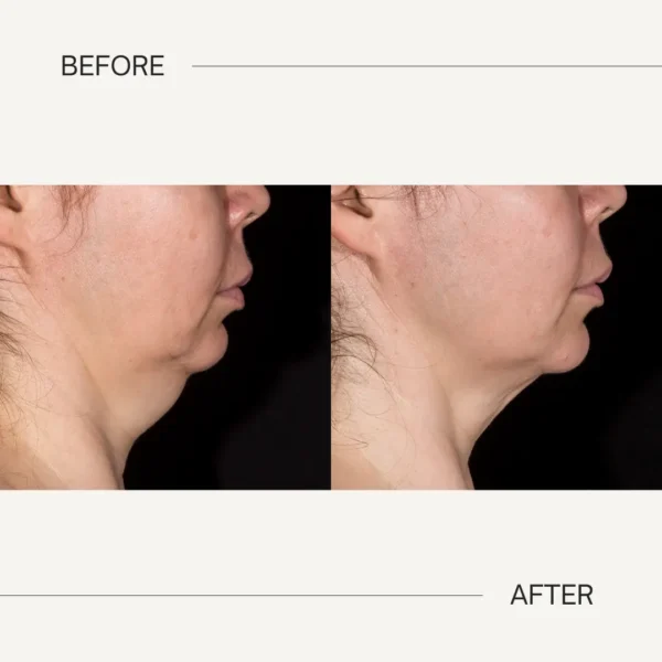 Double-Chin Reduction - Mejor Vida Medical Spa