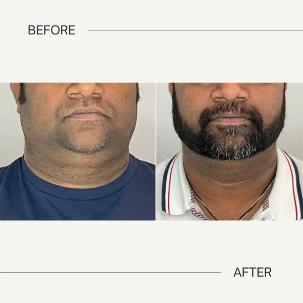 Double-Chin Reduction - Mejor Vida Medical Spa