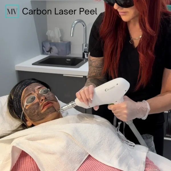 Hollywood Carbon Laser Peel - Mejor Vida Medical Spa
