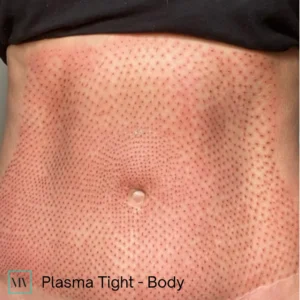 Plasma Tight Body - Mejor Vida Medical Spa