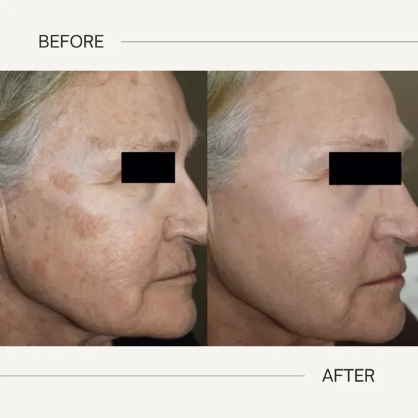 Pico Laser Skin Rejuvenation - Mejor Vida Medical Spa