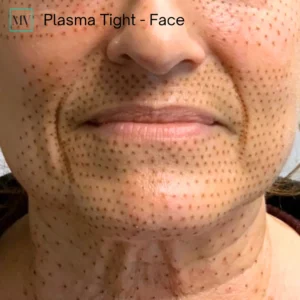 Plasma Tight - Face - Mejor Vida Medical Spa