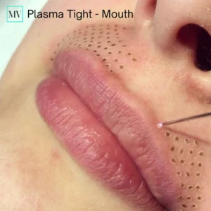 Plasma Tight - Mouth - Mejor Vida Medical Spa